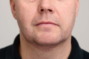 facial micropigmentation